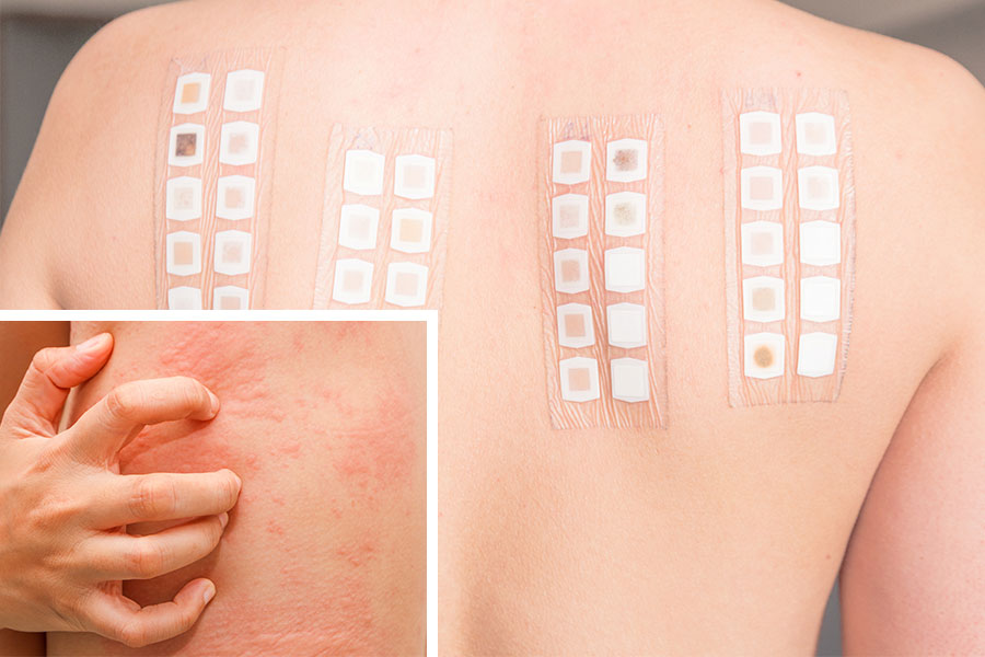esame-patch-test-diagnosticare-dermatite-allergica